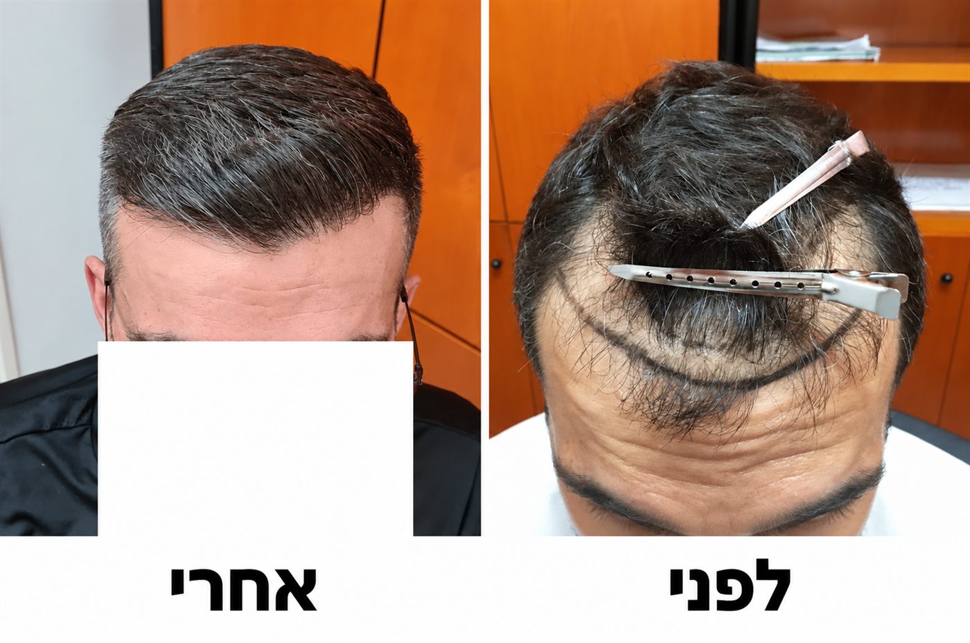 קו שיער קדמי ומפרצים, לפני ואחרי השתלת FUE