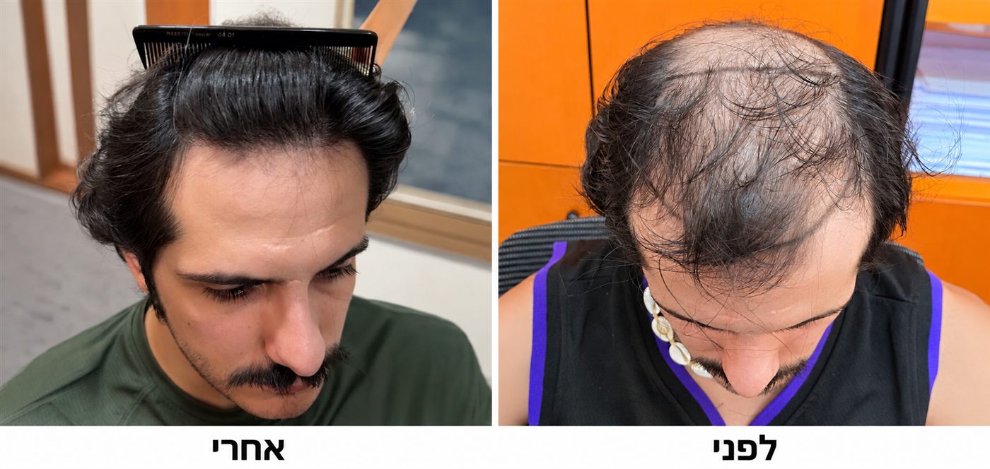 קודקוד וחלק קדמי, לפני ואחרי השתלת FUE