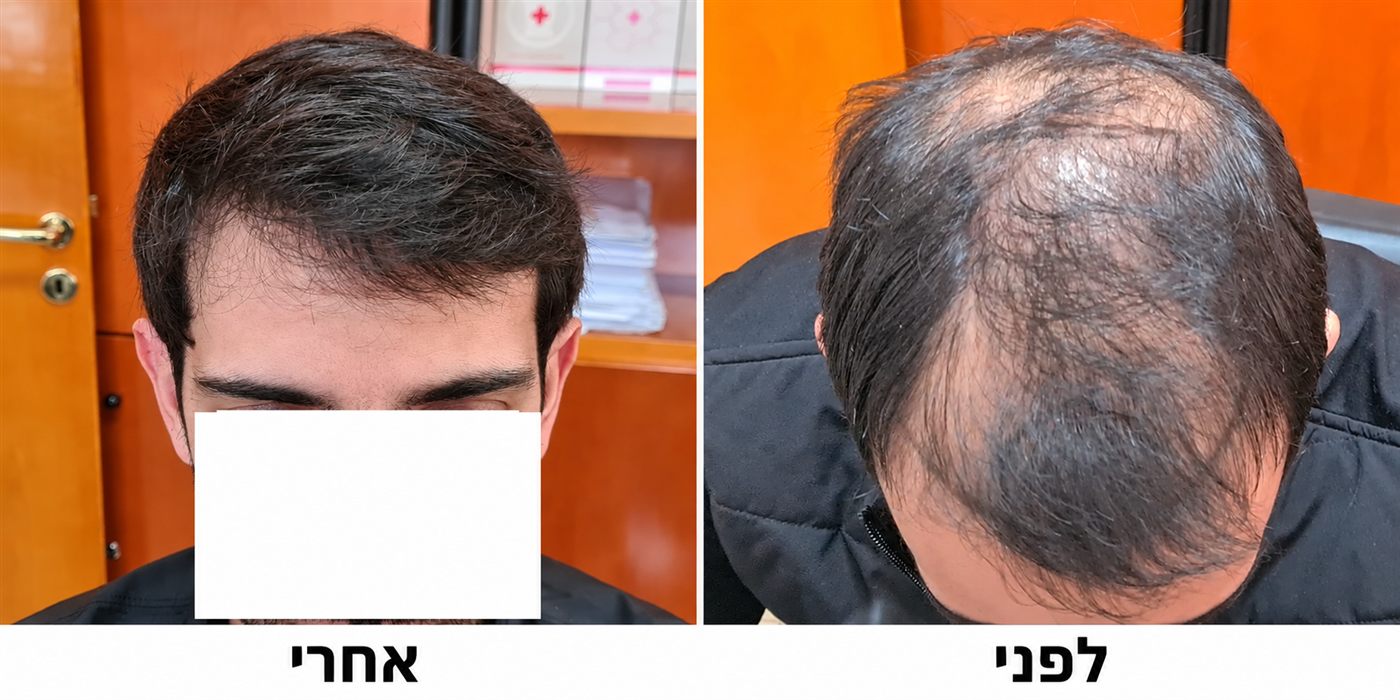 קודקוד מדולל, לפני ואחרי השתלת FUE