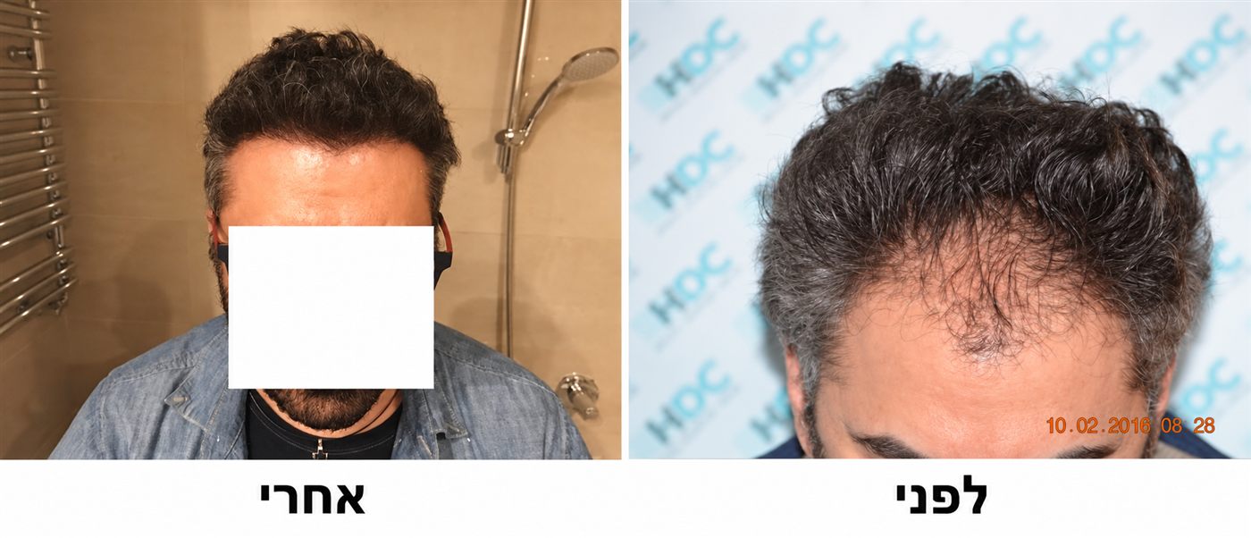 קו שיער קדמי, לפני ואחרי השתלת FUE