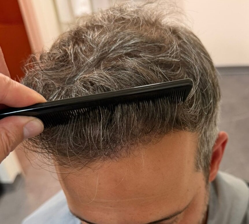 קו שיער של מטופל אחרי השתלת FUE במרפאת HDC, השיער מסורק לאחור
