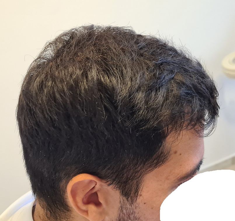 מטופל אחרי השתלת FUE, שיער מלא בקו השיער ובצד