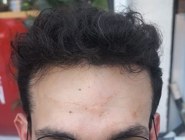 קו שיער קדמי של מטופל אחרי השתלת FUE