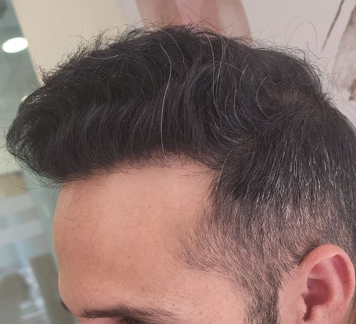 מטופל אחרי השתלת FUE, שיער צפוף מלפנים