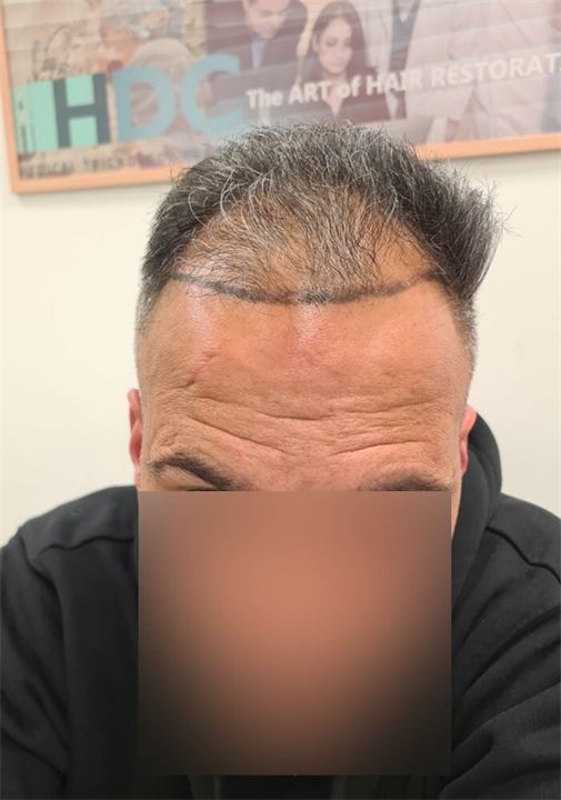 השתלת שיער בשיטת FUE כ 3800 זקיקים