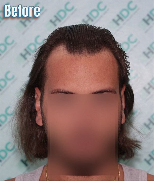 השתלת שיער FUE 2800 זקיקים