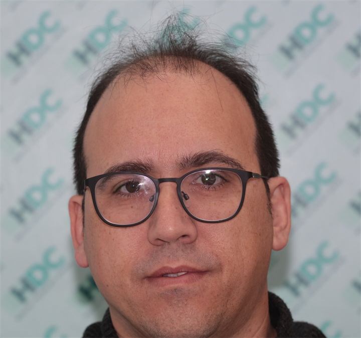 השתלת שיער FUE 4534 זקיקים