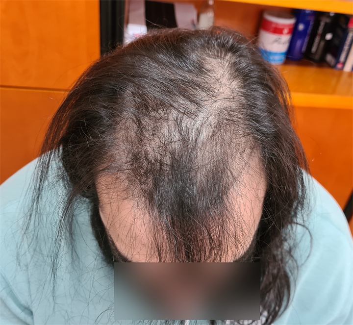 השתלת שיער FUE 4516 זקיקים