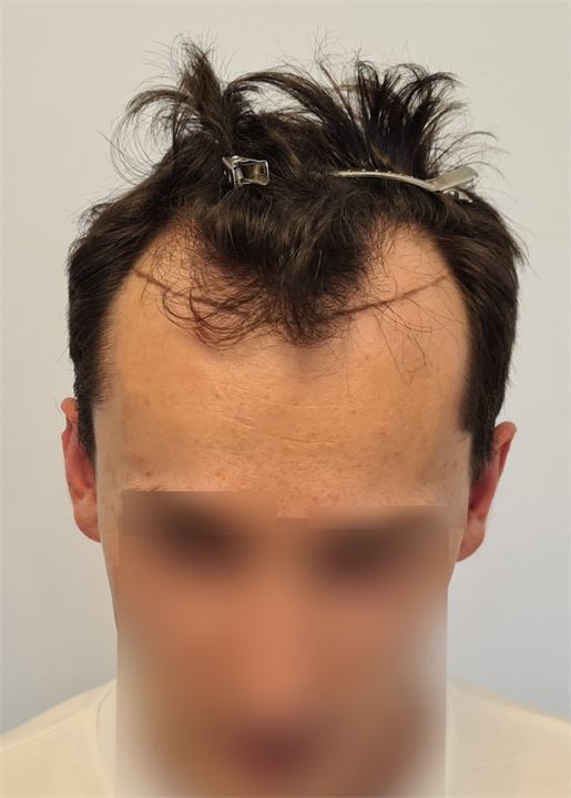 השתלת שיער FUE 3360 זקיקים