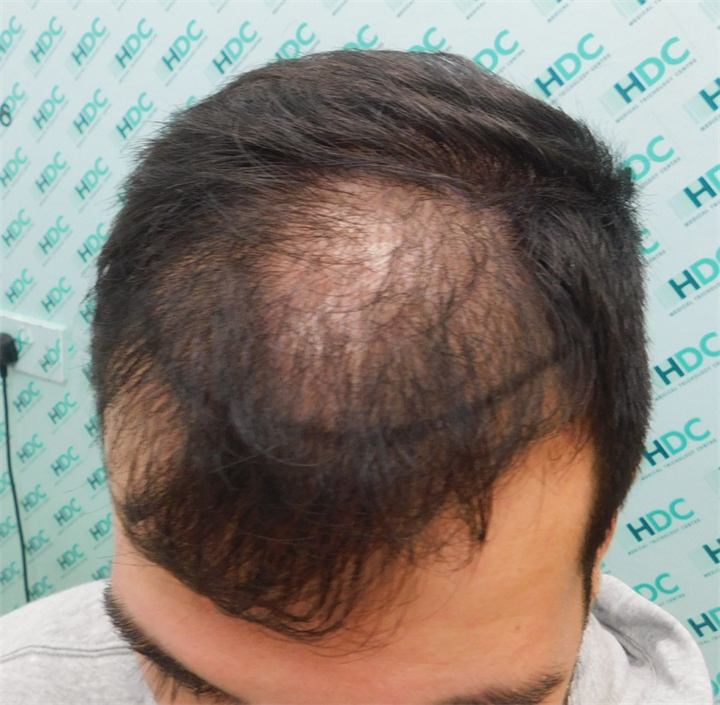 השתלת שיער FUE 3100 זקיקים