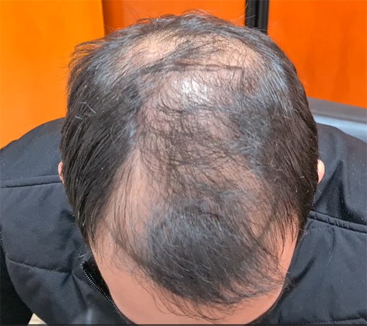 השתלת שיער בשיטת FUE עם 4000 זקיקים