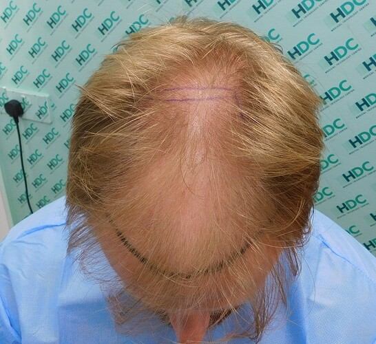 השתלת שיער בשיטת FUE כמות זקיקים 4568
