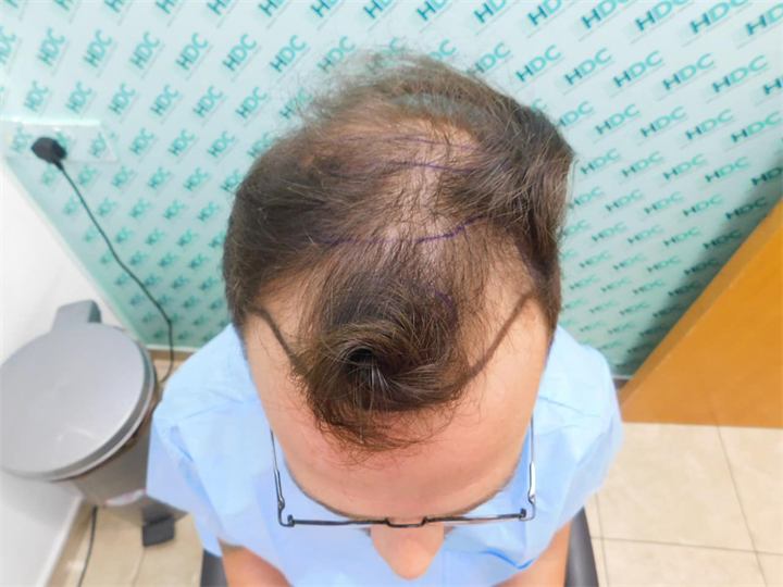 השתלת שיער בשיטת FUE 5155 זקיקים