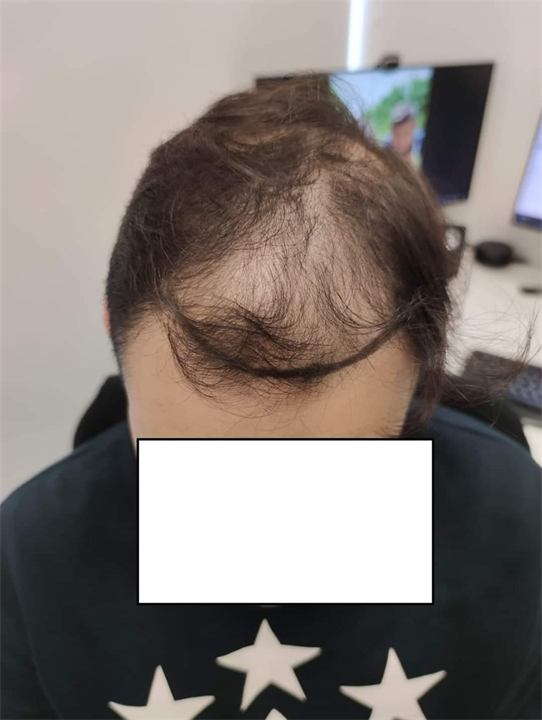 השתלת שיער בשיטת FUE 2520 זקיקים
