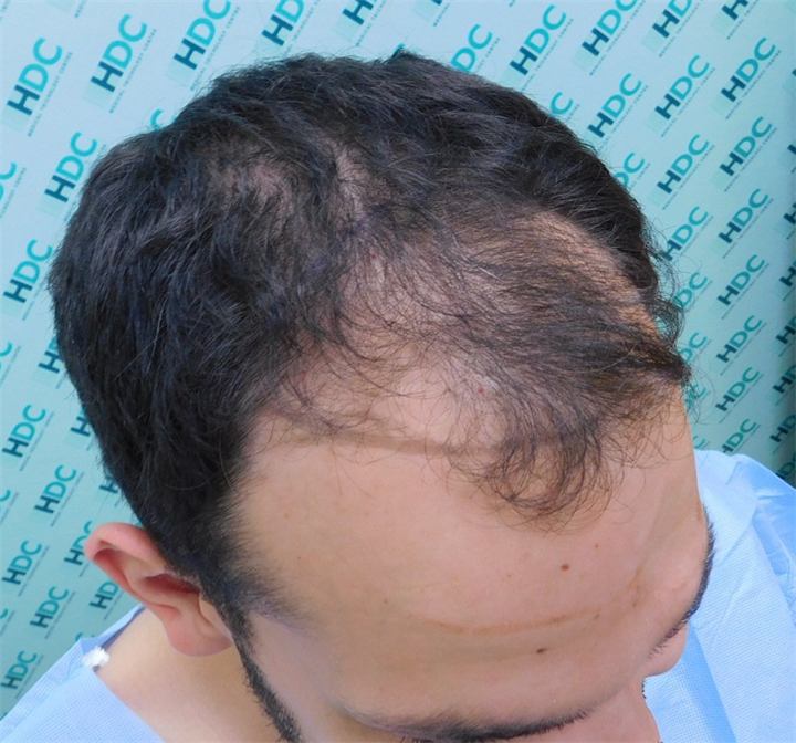 השתלת שיער FUE 3000 זקיקים נורווד 3