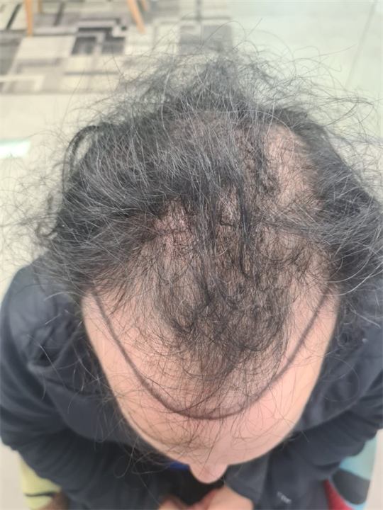השתלת שיער FUE 4000 זקיקים