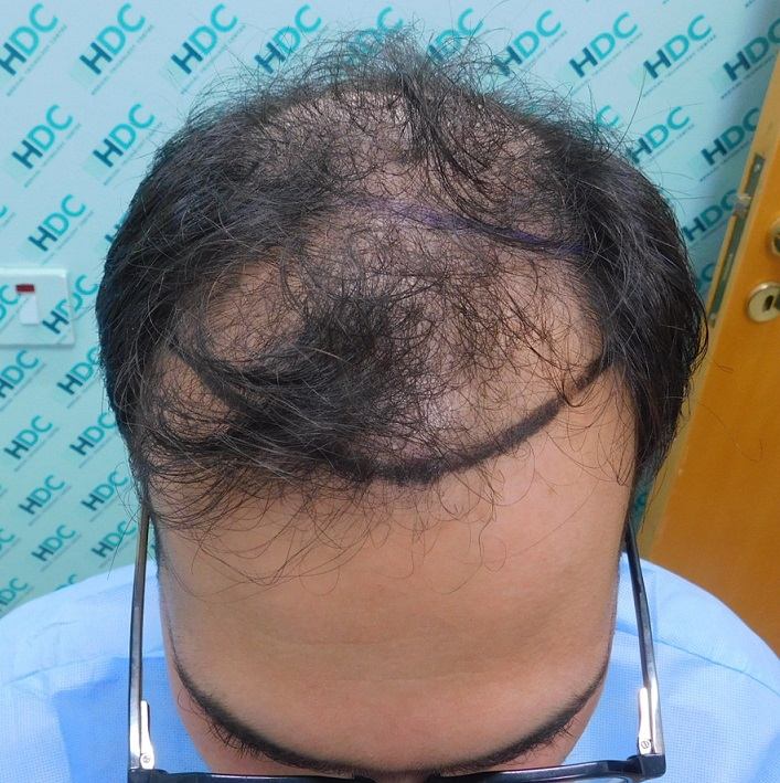 השתלת שיער 4900 זקיקים נורווד 5