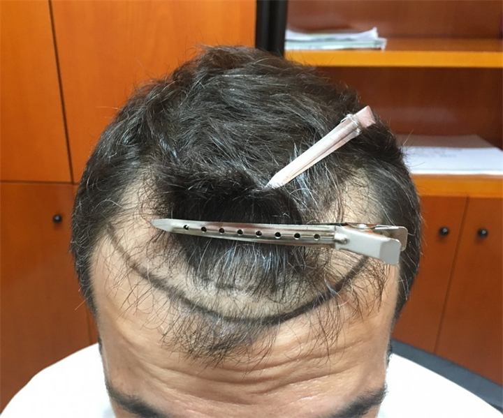 השתלת שיער 3748 זקיקים