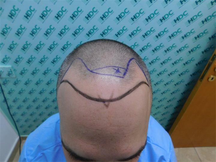 השתלת שיער FUE 3050 זקיקים