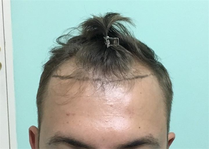 השתלת שיער FUE 2750 זקיקים קו שיער