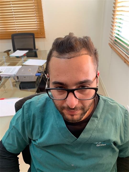 השתלת קו שיער שיטת FUE 2100 זקיקים