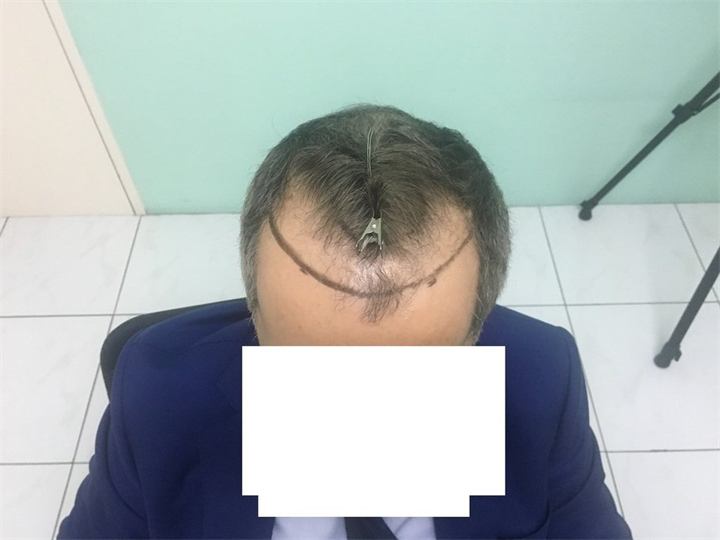 השתלת קו שיער 2800 זקיקים בשיטת FUE
