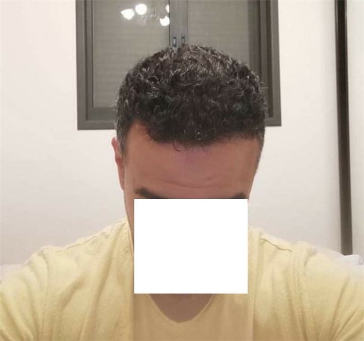השתלת שיער FUE 3200 זקיקים נורווד 5