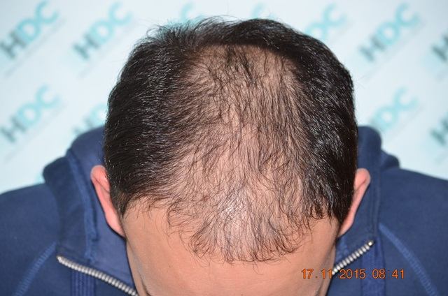 השתלת שיער כמות של 4800 זקיקים – בשני טיפולים עם הפרש של שנה בין טיפול לטיפול
