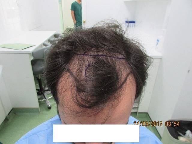 השתלת שיער FUE כמות של 2100 זקיקים