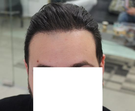 השתלת שיער FUE בכמות של 3008 זקיקים לנורווד 5