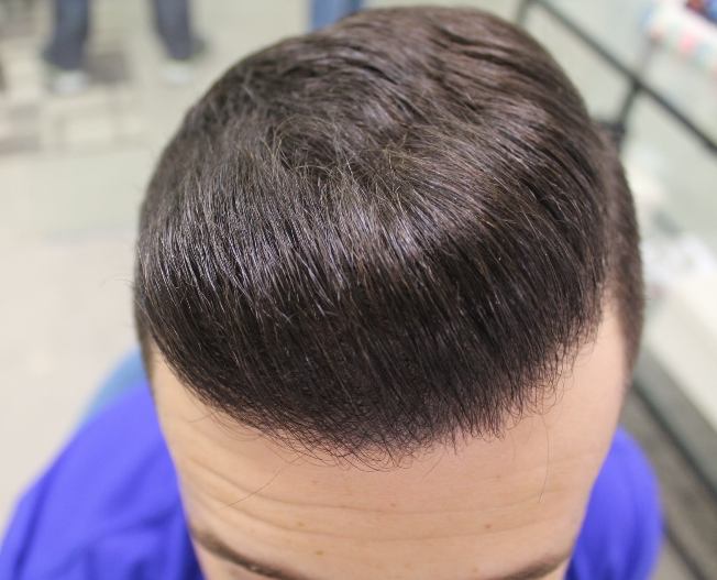 השתלת שיער FUE כמות של 3056 זקיקים
