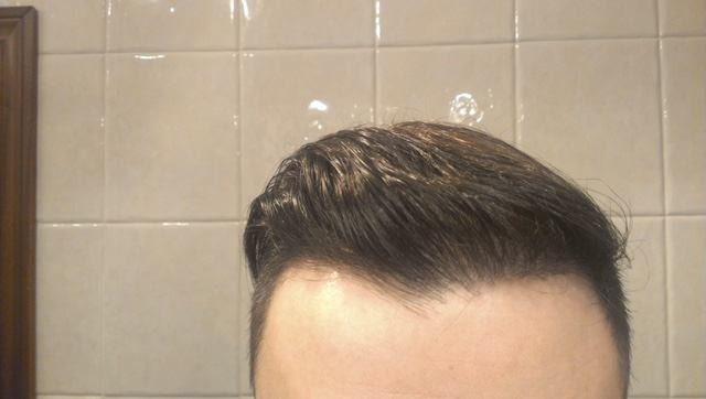 השתלת שיער חלק קדמי 2400 זקיקים