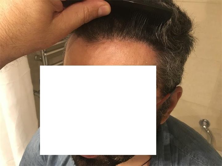 השתלת שיער חלק קדמי 2700 זקיקים