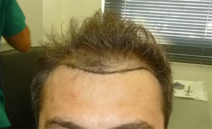 השתלת שיער FUE כמות של 2068 זקיקים