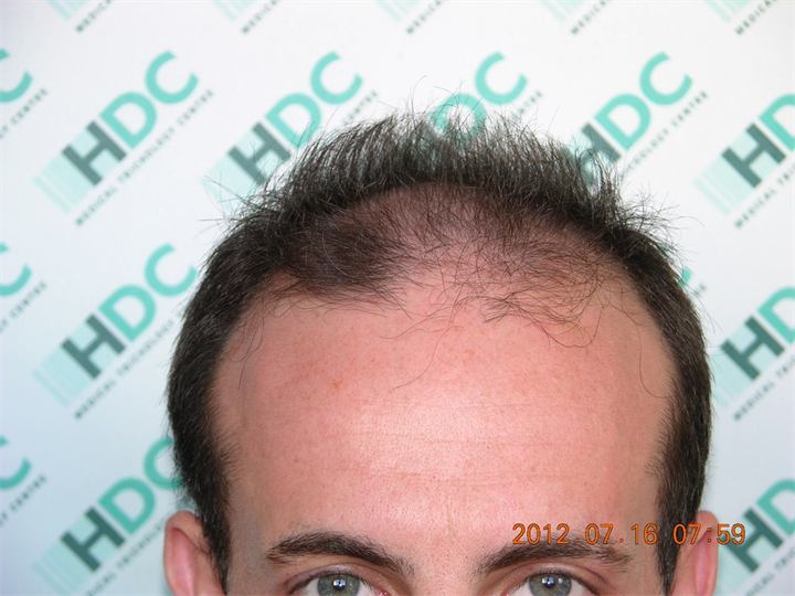 השתלת שיער FUE כמות של 3400 זקיקים