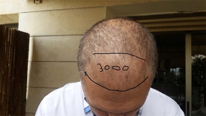 השתלת שיער FUE כמות של 3116 זקיקים