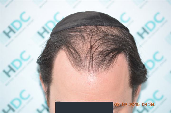 השתלת שיער FUE לנרווד 5, כמות של 2905 זקיקים