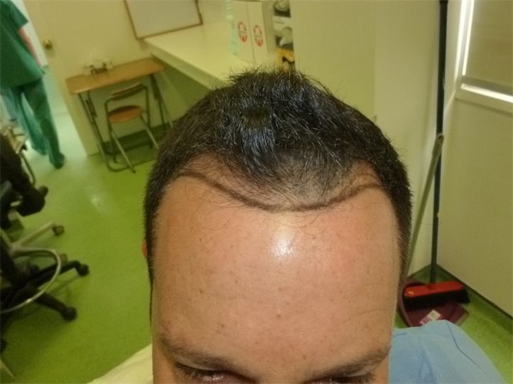 המנכת קו שיער – 1800 זקיקים בשיטת ה fue
