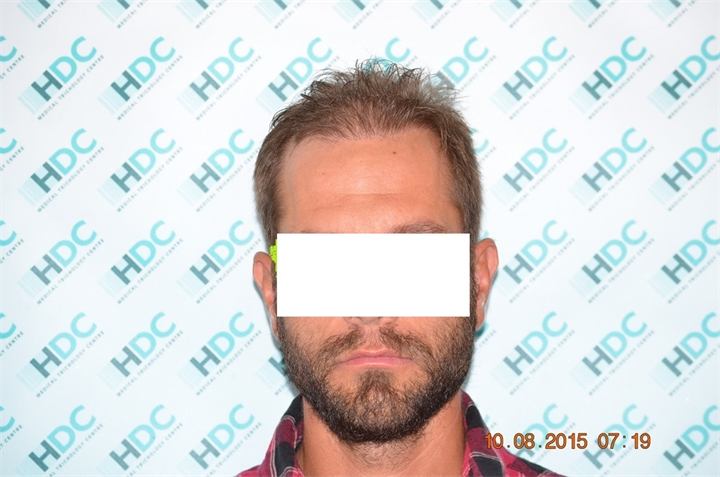 תיקון השתלת סטריפ – 3000 זקיקים בשיטת ה fue