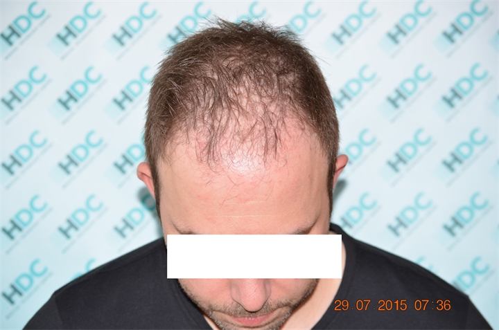 השתלת שיער – 3100 זקיקים בשיטת ה fue
