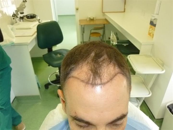 השתלת שיער – 2500 זקיקים בשיטת ה fue