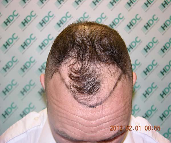 השתלת שיער 3050 זקיקים בשיטת ה fue