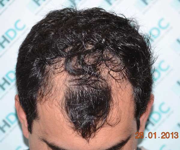 השתלת שיער במפרצים 3045 זקיקים בשיטת ה fue