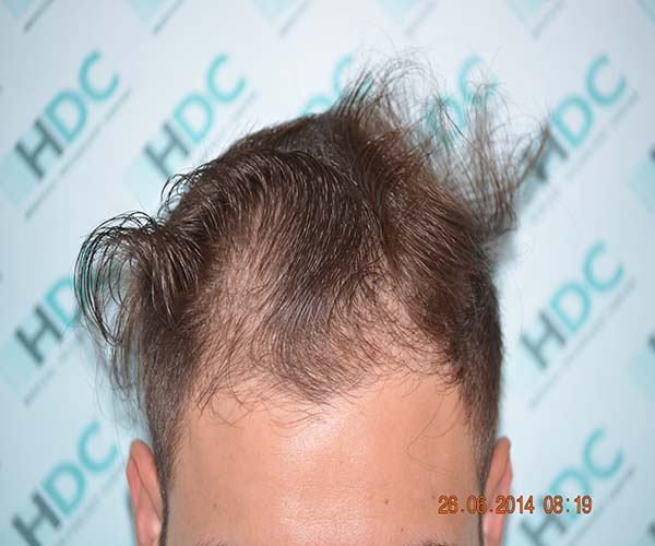 השתלת שיער – 2014 זקיקים בשיטת ה fue