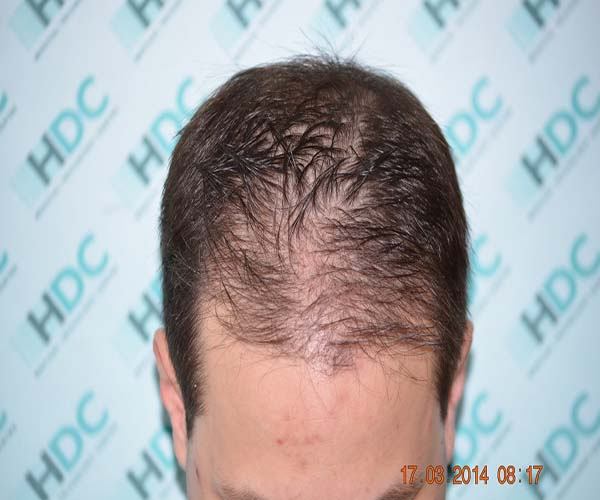 השתלת שיער לנרווד 5 – סה"כ 3050 זקיקים בשיטת ה fue