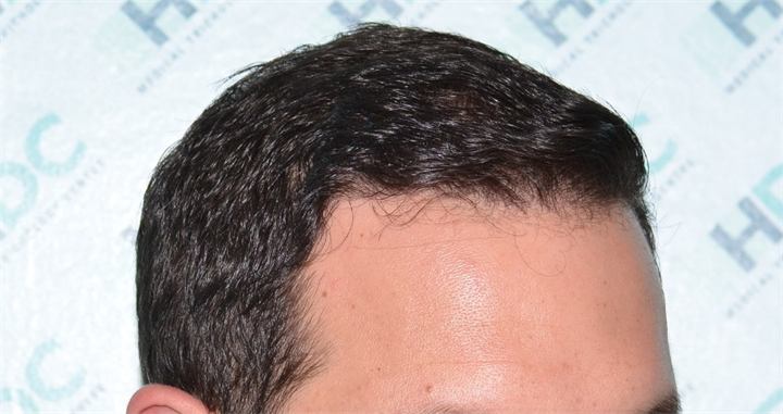 השתלת שיער במפרצים – 2900 זקיקים בשיטת ה FUE