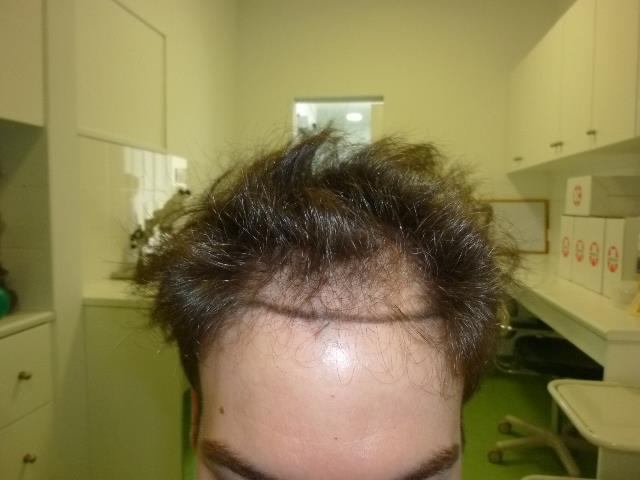 השתלת שיער 2412 זקיקים בשיטת ה FUE