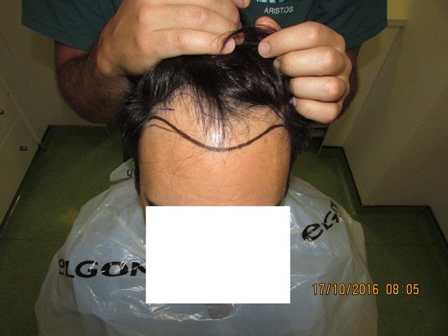 השתלת שיער באזור הקו שיער והמפרצים – 2700 זקיקים בשיטת ה fue