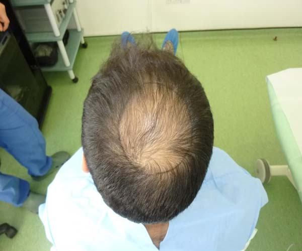 השתלת שיער באזור הכתר – זקיקים 2200 בשיטת fue